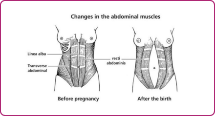 Changes in the abdominal muscles during pregnancy