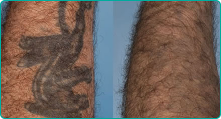 Single Colour Tattoo Removal - Bristol Laser Centre | North Bristol ...