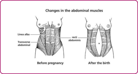 Changes in the abdominal muscles during pregnancy Changes in the abdominal muscles during pregnancy
