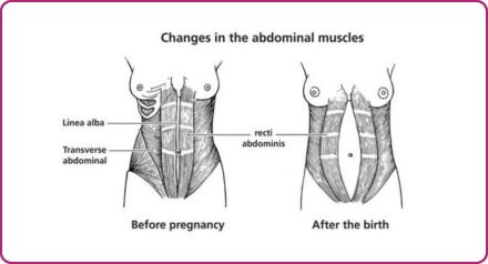 Divarication of Abdominal Muscles