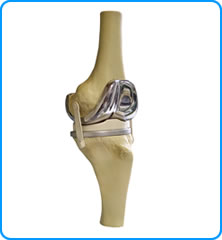 Knee replacement illustration Knee replacement illustration