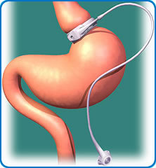 Gastric Band