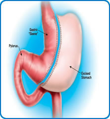 Sleeve Gastrectomy