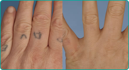 Tattoo Removal Mumbai Permanent Laser Tattoo Removal Treatment Cost India   The Esthetic Clinics