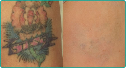 Can Laser Tattoo Removal Work for Me  Milford Franklin MA  MacMed Spa