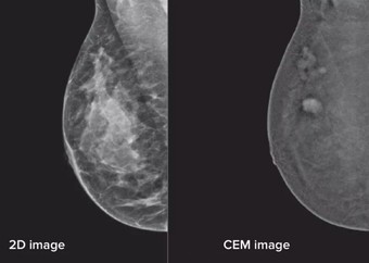 Mammography scan images, on the left 2D imaging, on the right contrast enhanced imaging