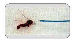 Picture of a clot that has been removed