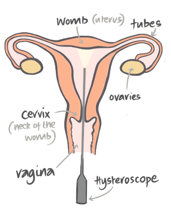 Illustration of uterus, cervix, ovaries, and vagina with a hysteroscope