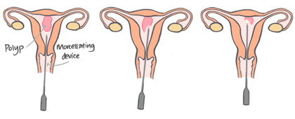 Ilustration of 3 stages of removing a polyp during a hysteroscopy
