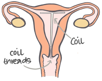 Illustration of uterus and a contraceptive coil inserted