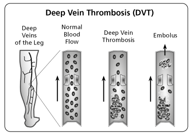 Diagram of leg and vein with deep vein thrombosis forming and moving to an embolus
