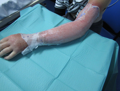 Initial application of Biobrane. A patients arm wrapped in biobrane.