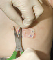 Biobrane being trimmed with scissors