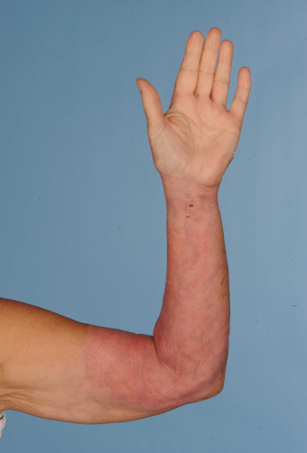 Patients arm after 14 days of treatment with Biobrane removed.