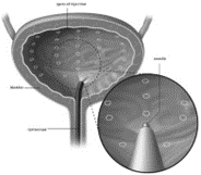 Bladder botox injection Bladder botox injection