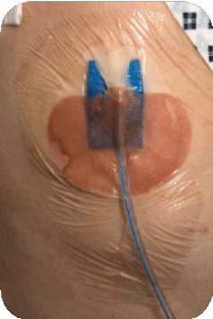 Close up view of a patient's chest drain (small blue wire) with a stitch and waterproof dressing.