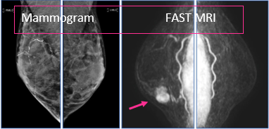 Mammogram vs FAST MRI image showing breast lump (on right)
