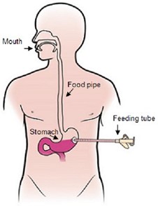Illustration of feeding tube placement through the skin into the stomach.