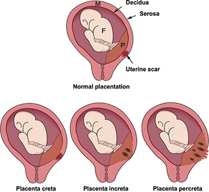 illustration of normal placenta, placenta accreta, placenta increta and placenta percreta