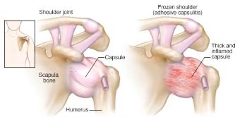 Diagram of normal shoulder showing bones and capsule vs frozen shoulder joint 