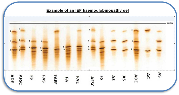 Isoelectric Focussing Gel separates the proteins into bands.