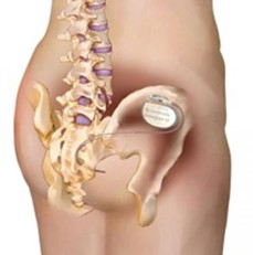 Diagram of implanted sacral neuromodulation device in buttock