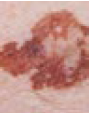 Melanoma with an uneven border