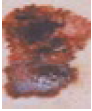 Melanoma with uneven colours