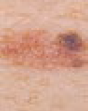 Melanoma with a change in size, shape, colour or elevation