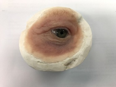 Orbtial prosthesis Orbtial prosthesis