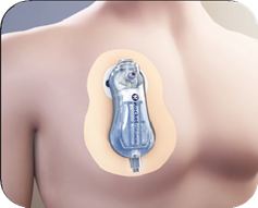 Illustration of pleural vent after insertion