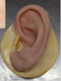 Prosthetic ear Prosthetic ear