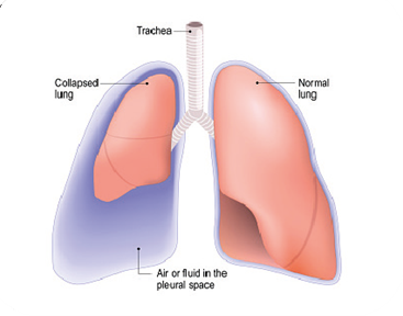 Illustration of lungs with right-sided pneumothorax