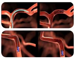 Picture of stent retrieval of a clot