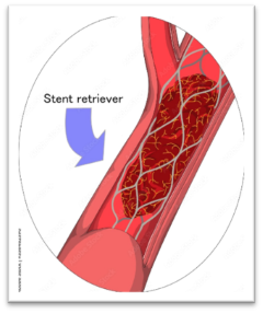 Stent clot retrieval Diagram or artery with stent retriever around blood clot