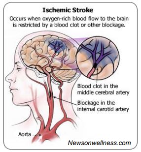 Ischemic stroke image