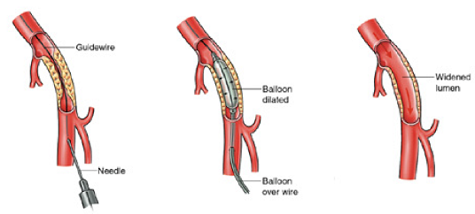 Diagram of an angiogram Diagram of a balloon angioplasty