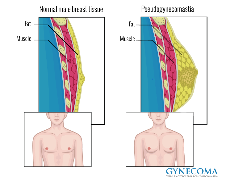 A diagram showing the difference between normal and enlarged male breast tissue