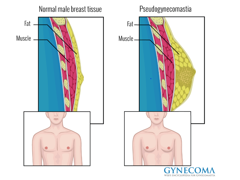 Male Breast Gynaecomastia North Bristol Nhs Trust