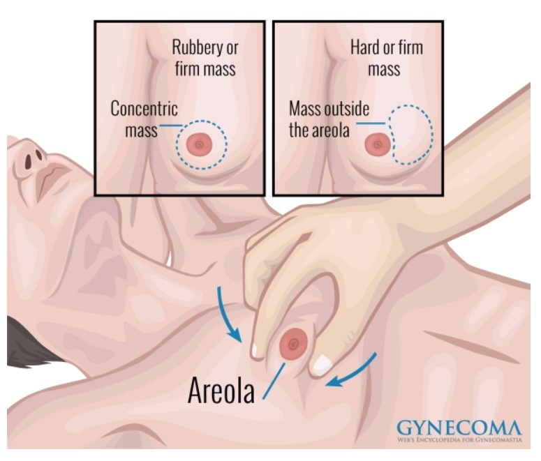 A diagram showing the variety in amount of excess tissue growth from a small amount of extra tissue around the nipples to enlarge breasts