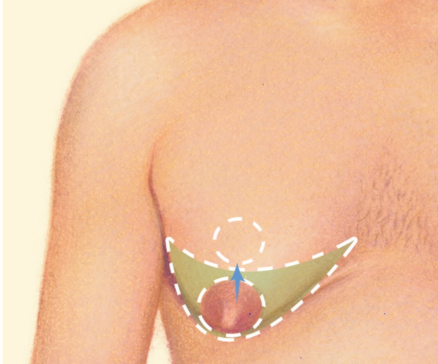 A diagram showing a direct excision. The image shows where the surgeon will make a semi-circular incision (cut) around the areola (nipple) edge and remove the excess layer of tissue.
