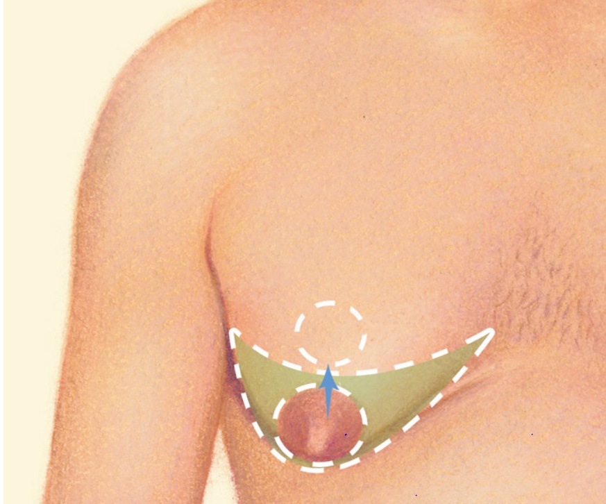 A diagram showing a direct excision. The image shows where the surgeon will make a semi-circular incision (cut) around the areola (nipple) edge and remove the excess layer of tissue. A diagram showing a direct excision. The image shows where the surgeon will make a semi-circular incision (cut) around the areola (nipple) edge and remove the excess layer of tissue.