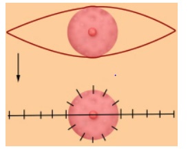 A diagram showing where the surgeon will make a semi-circular cut around the areola and where the stitches will be placed. A diagram showing where the surgeon will make a semi-circular cut around the areola and where the stitches will be placed.