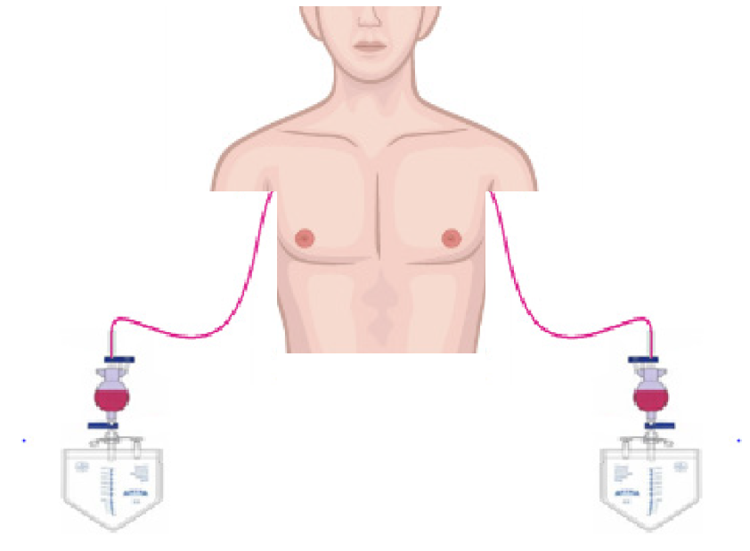A diagram showing two chest drains inserted into each side of a man's chest.