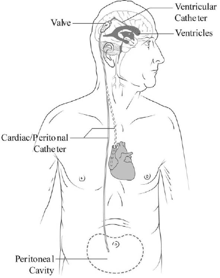 Ventriculo-peritoneal (VP) shunt