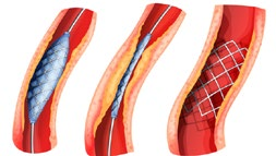 Stent Stent