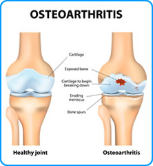 Osteoarthritis in joint