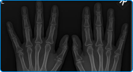 How is Rheumatoid Arthritis Investigated How is Rheumatoid Arthritis Investigated