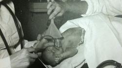 Black and white photo of Resuscitation of a baby. Endotracheal insufflation of oxygen.